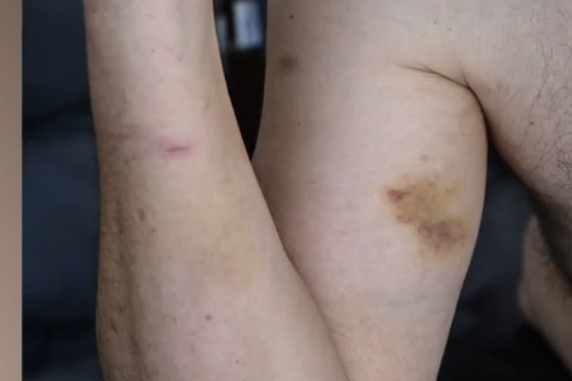 Επιχειρηματίας στη Μύκονο υπέστη άγριο ξυλοδαρμό από αστυνομικούς