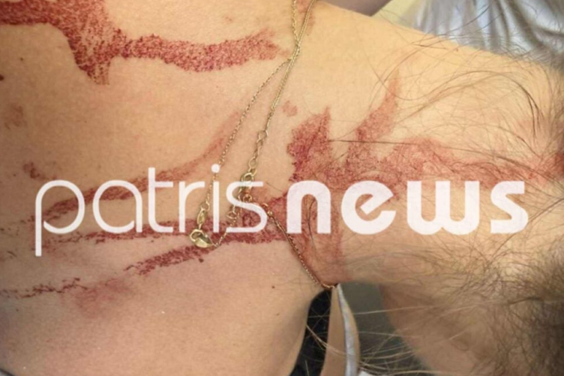 Βίαιη επίθεση με ψαλίδι στην Αμαλιάδα: Σοβαρός τραυματισμός γυναίκας