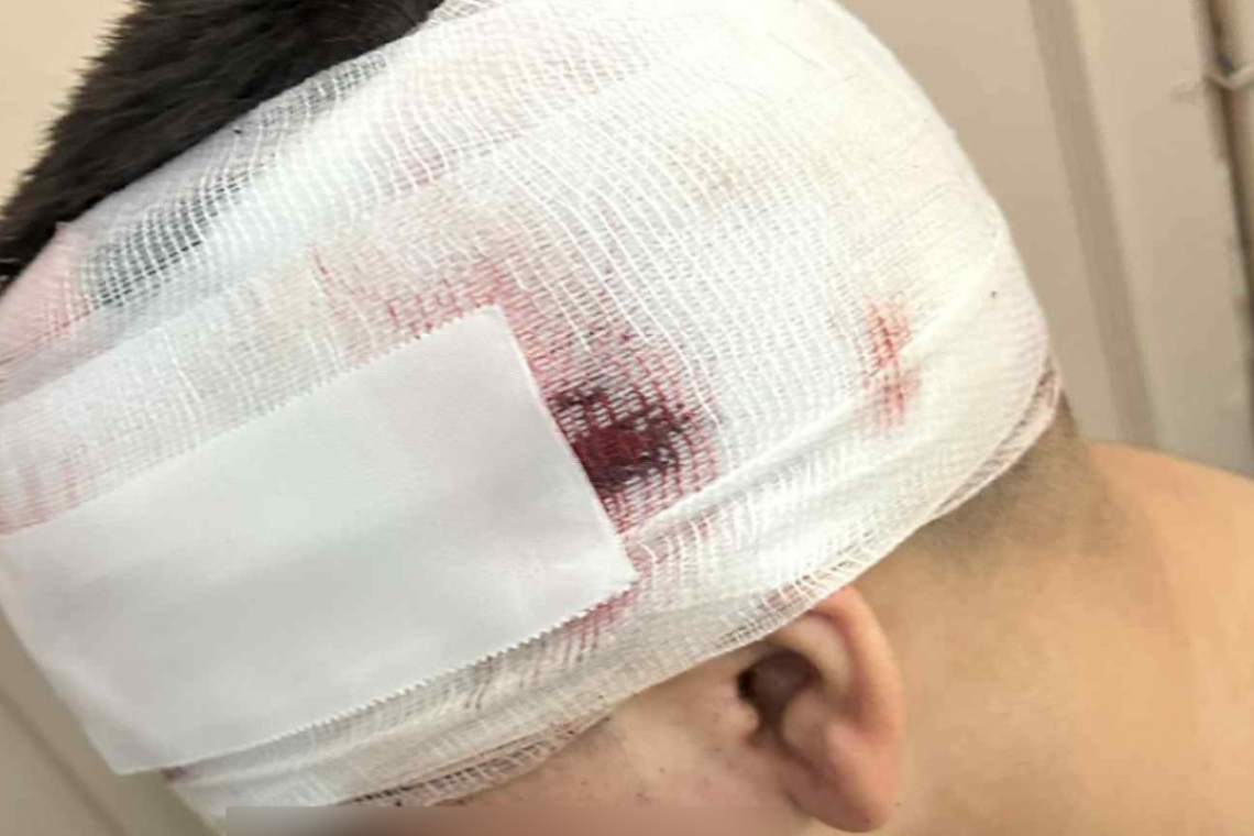Θεσσαλονίκη: Ξυλοδαρμός 13χρονου, κατ’ οίκον περιορισμός για τον 18χρονο δράστη