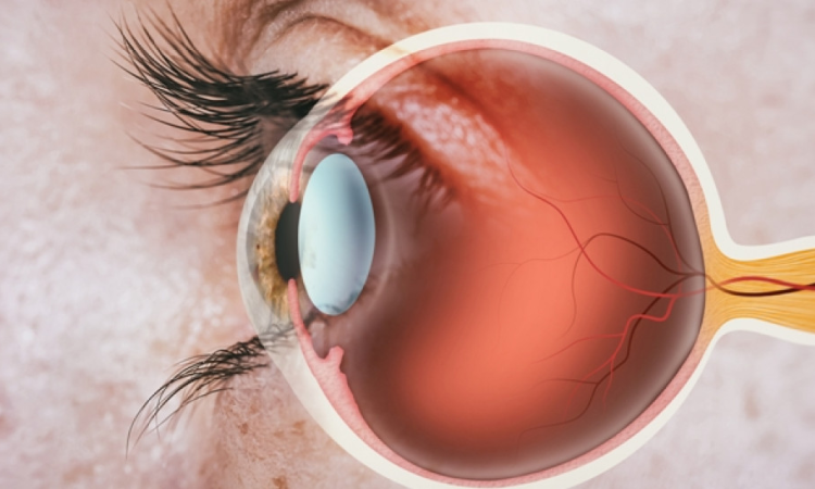 Σύστημα τεχνητής νοημοσύνης διαβάζει τον κίνδυνο εμφράγματος από τα μάτια